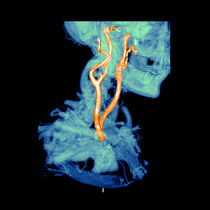 3D CTA of Carotid Arteries by sciencesource