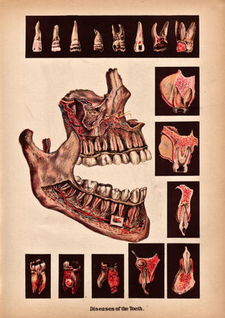 Diseases-of-the-teeth